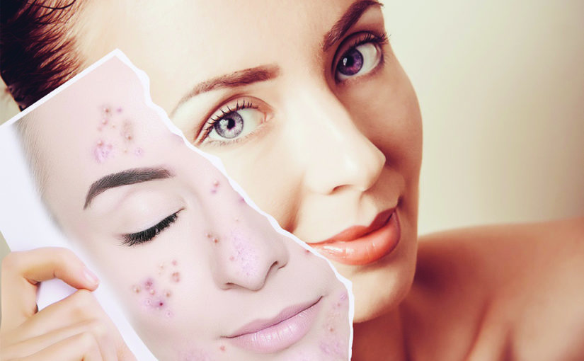 മുഖക്കുരു ശല്യം ഒഴിവാക്കാം