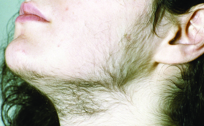 പെൺകുട്ടികളിൽ അമിത രോമ വളർച്ച എന്തുകൊണ്ട്?