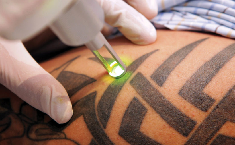 ടാറ്റു നീക്കം ചെയ്യാം വേദനയില്ലാതെ