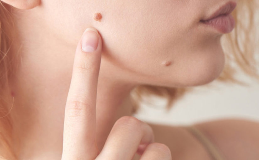 മുഖത്ത് അരിമ്പാറ ഉണ്ടോ?