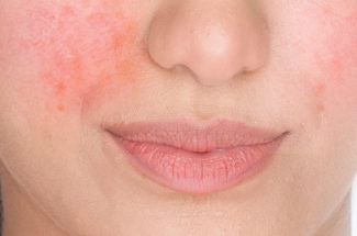 rosacea