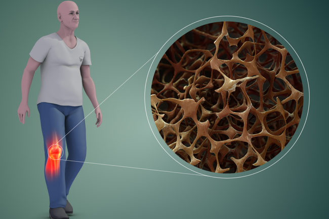 Osteoporosis വരാതിരിക്കാൻ എന്ത് ചെയ്യണം