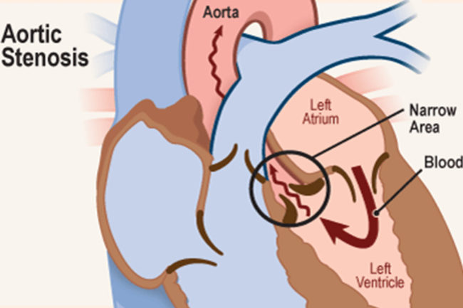 Aortic stenosis: സമയബന്ധിത ചികിത്സ ആവശ്യം