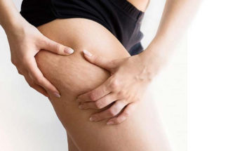 Health- cellulite