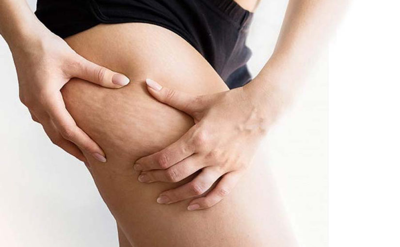 സെല്ലുലൈറ്റ് നീക്കാം ആരോഗ്യം കാക്കാം