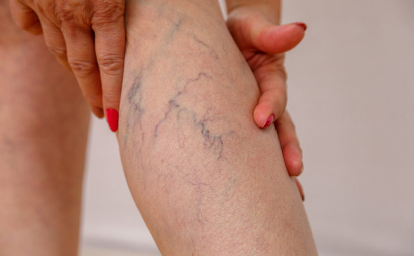 വെരിക്കോസ് വെയിൻ പ്രശ്‌നവും പരിഹാരവും