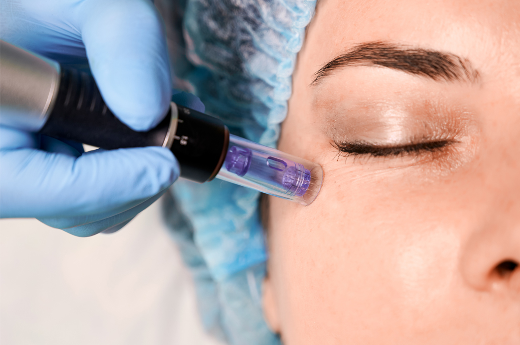 നോ നീഡിൽ മെസോതെറാപ്പി